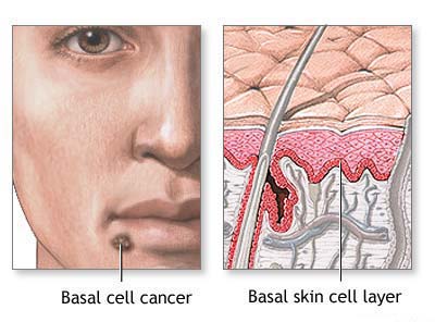 Facia Skin Cancer