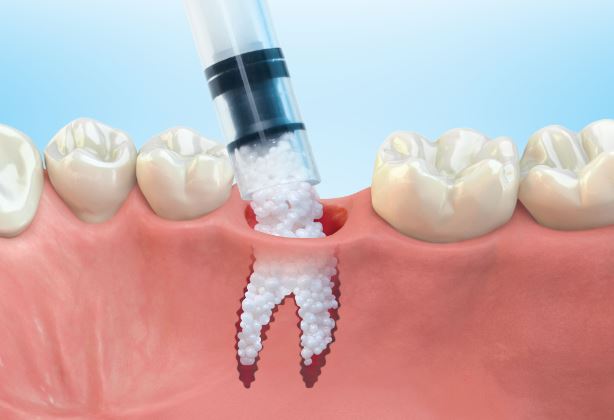 Bone Grafting