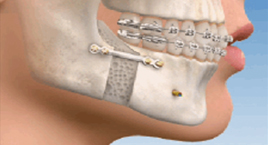 Orthognathic Jaw Surgery
